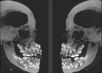 В Индии хирурги удалили семилетнему мальчику 80 зубов (видео)
