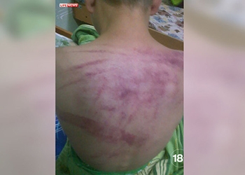 В иркутском детдоме воспитательница избила мальчика-инвалида
